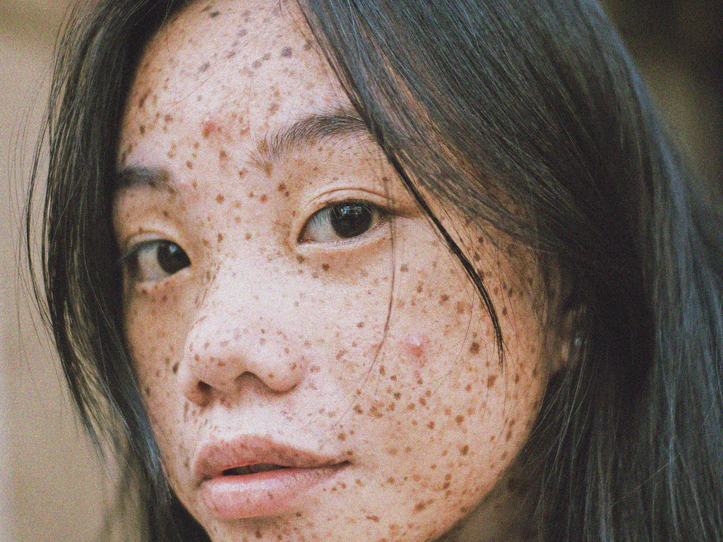 Akne kan være hård ved huden - og ved selvværdet