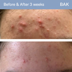 Oil for Acne-prone Skin BAK Skincare Danmark